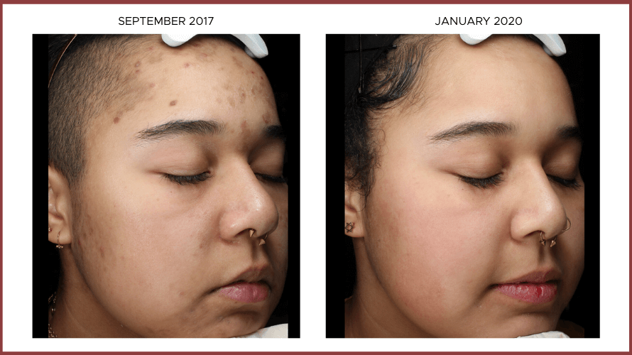 Before After Photos: Tranexami